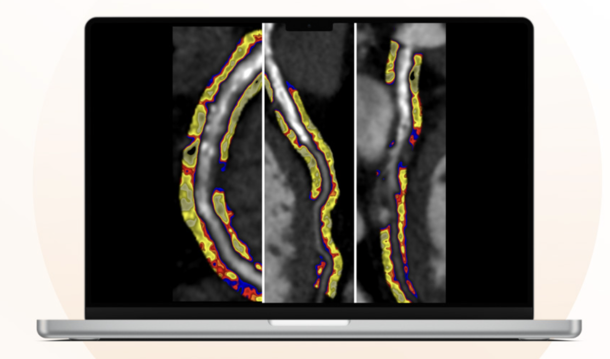 Landmark Clinical Study in The Lancet Finds New AI Technology Can